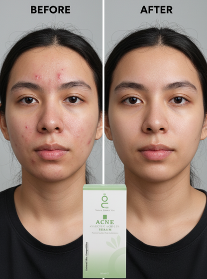 Acne Salicylic Acid 2. Advanced Acne Treatment | Deep Pore Cleansing, Oil Control